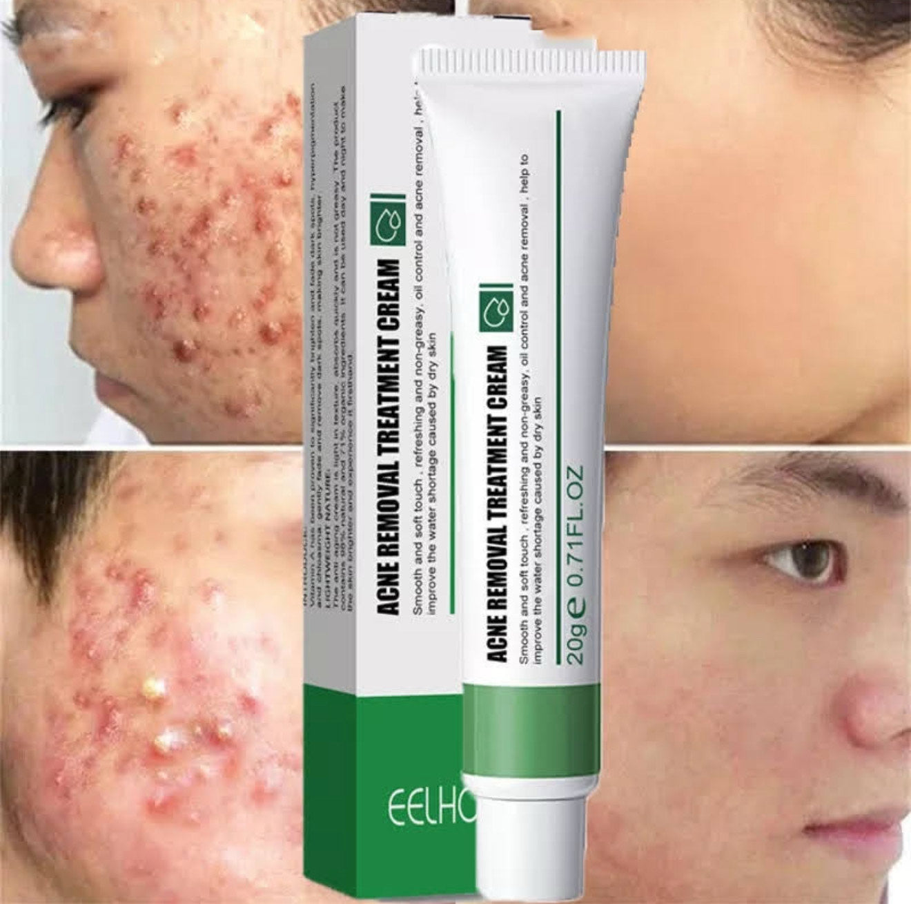 Chinese Herbal Acne Removal & Skin Brightening Cream – 20g